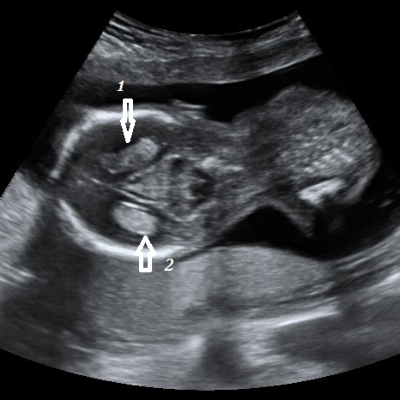 Gynecology Ultrasound